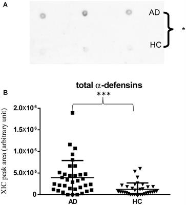 Top-Down Proteomics of Human Saliva Highlights Anti-inflammatory, Antioxidant, and Antimicrobial Defense Responses in Alzheimer Disease